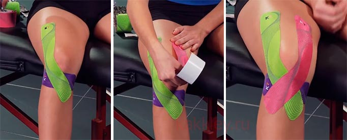 Как зафиксировать связки колена тейпом